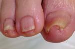 巻き爪や陥入爪の痛みを爪の矯正治療で改善しますに関する画像です。