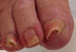 巻き爪や陥入爪の痛みを爪の矯正治療で改善しますに関する画像です。